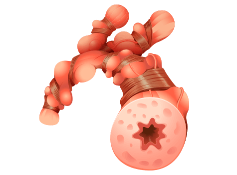 illustration of an inflamed bronchiole tube