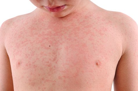 Hives on Young Man's Chest