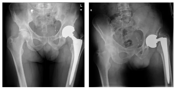 X-ray of Wright's Profemur and Conserve Hip Implants