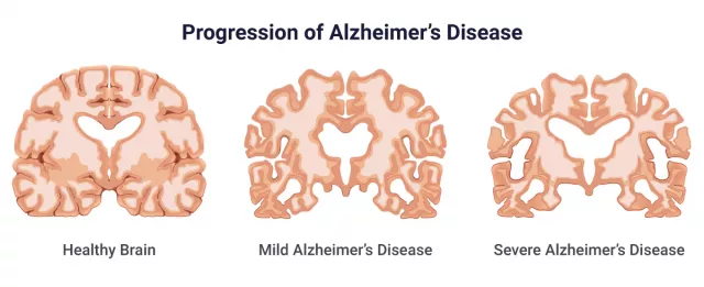 Alzheimer’s Disease: Causes, Stages, Symptoms & Prevention