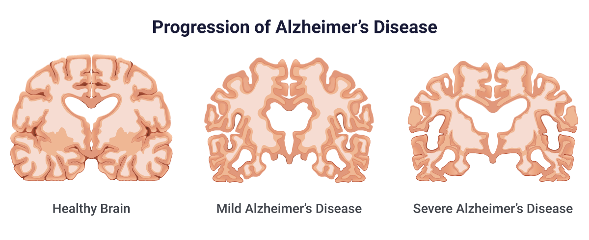 Является ли болезнь Альцгеймера генетической? Прогрессирование болезни Альцгеймера показано в качестве иллюстрации 