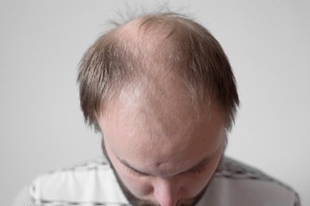 Middle Aged Man with Hair Loss