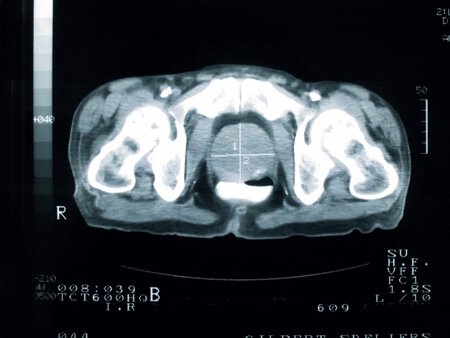 Prostate Cancer X-Ray View