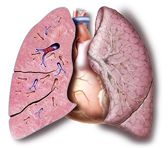 Pulmonary Artery Blocked by an Embolus