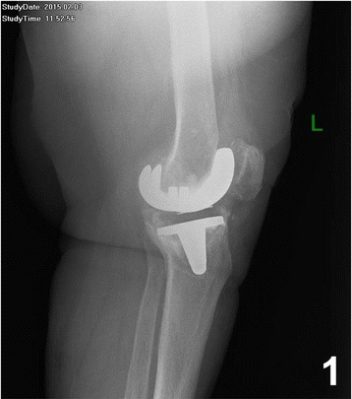 Radiography of a knee showing a loosening of the prosthesis