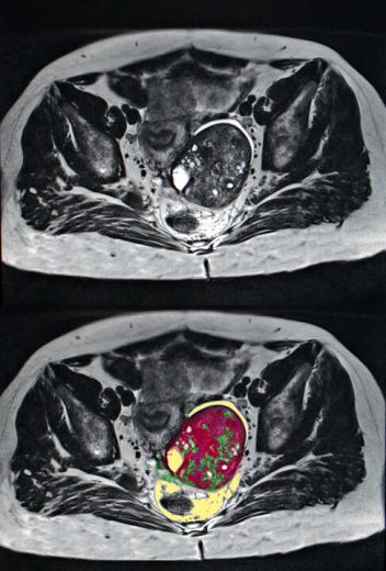 Ovarian cancer scan