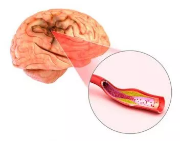 Stroke Impact on the Brain