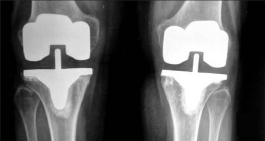 Knee Replacement X-Ray