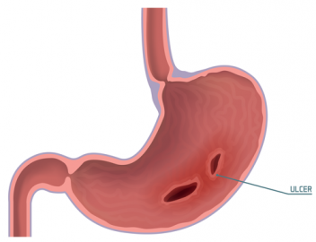 Illustration of a stomach ulcer