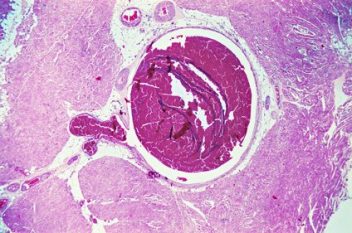 Deep Vein Thrombosis Micrograph