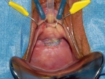 Surgical Mesh Being Used to Repair Pelvic Organ Prolapse