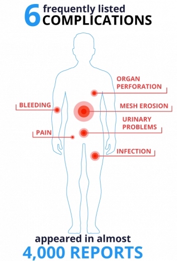 Frequent Mesh Complications Diagram
